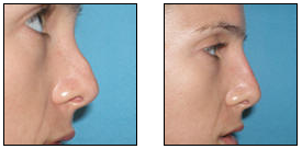 Non-Surgical Nose Job