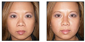 Non-Surgical Nose Job