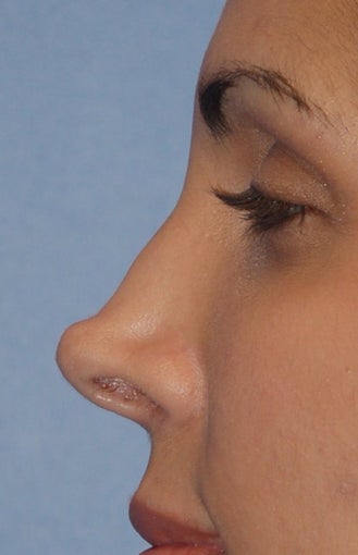 Non-surgical Revision Rhinoplasty