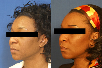 Facelift, Laser Skin Rejuvenation