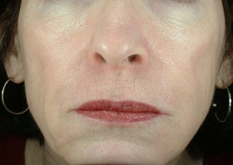 Liquid Facelift (Injectables)