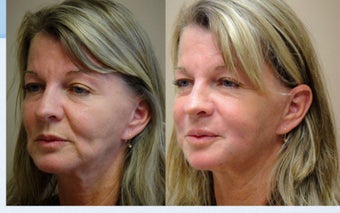 Liquid Facelift with Female