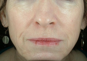 Liquid Facelift (Injectables)