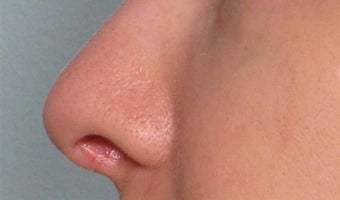 Juvederm in the nose