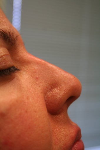 Non-surgical Rhinoplasty