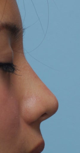 Non Surgical Rhinoplasty