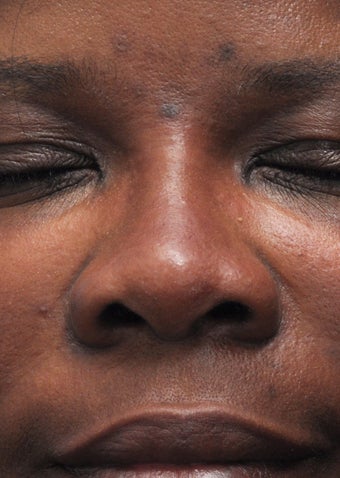 Non Surgical Rhinoplasty
