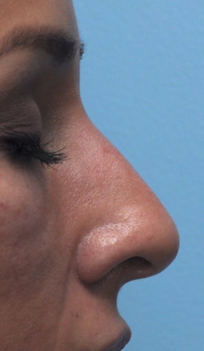 Non Surgical Rhinoplasty