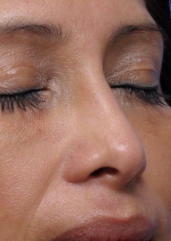 Non-Surgical Nose Job