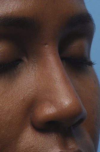 Non-Surgical Nose Job