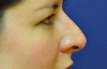 Non-Surgical Rhinoplasty