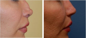 Non-Surgical Rhinoplasty