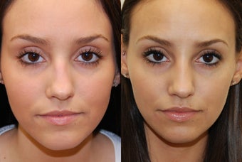 Non-Surgical Rhinoplasty with Silikon-1000. 3 treatments.