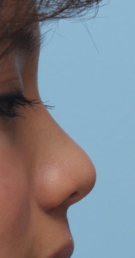 Non Surgical Rhinoplasty