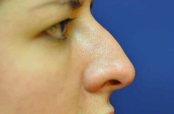 Non-Surgical Rhinoplasty
