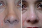 Non Surgical Rhinoplasty