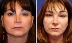 Non Surgical Rhinoplasty