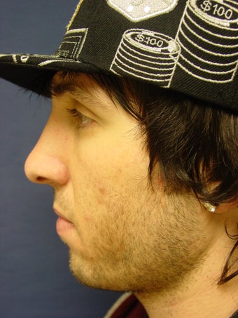 Rhinoplasty