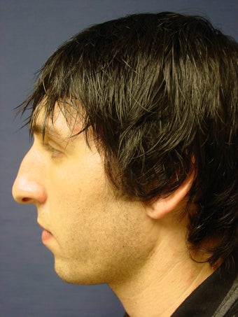 Rhinoplasty