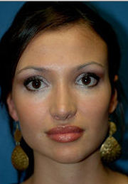 Rhinoplasty