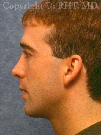 Rhinoplasty