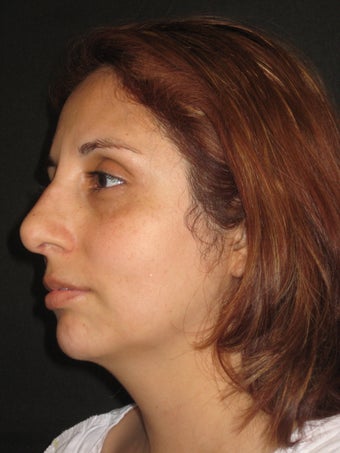 Rhinoplasty and Septoplasty