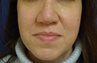Rhinoplasty