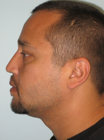 Nasal Reconstruction