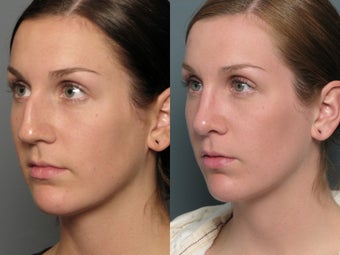 Nose Surgery