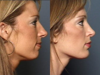 Nose Surgery