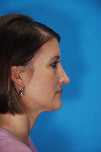 Rhinoplasty