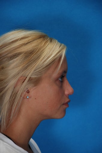 Rhinoplasty (nose job, nasal surgery)