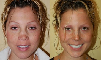 Revision Rhinoplasty Nose Surgery