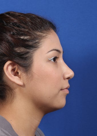 nasal airway surgery with cosmetic benefits