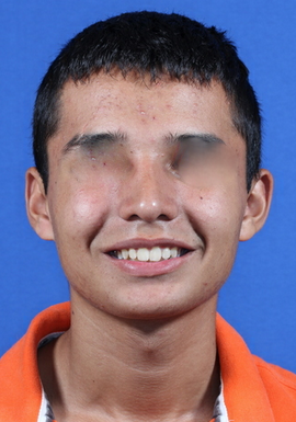 nasal airway surgery with cosmetic improvement