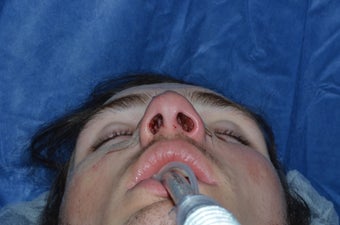 Closed Nasal Reduction (Resetting Broken Nose)