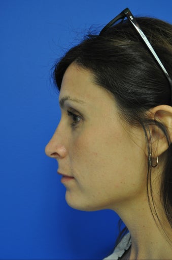 Nose surgery/Rhinoplasty