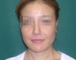 Nose Surgery -Rhinoplasty