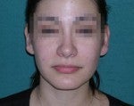Rhinoplasty