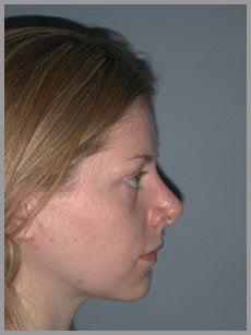 Nose Surgery, Rhinoplasty