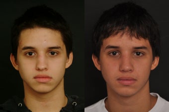 Rhinoplasty