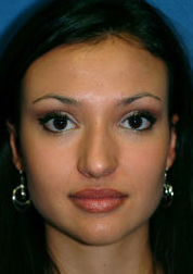 Rhinoplasty
