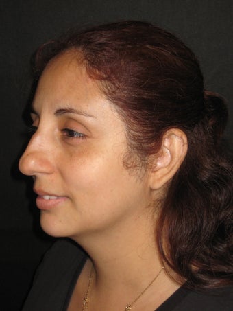Rhinoplasty and Septoplasty