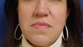 Rhinoplasty