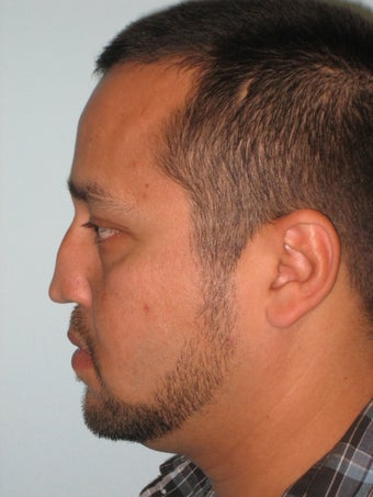 Nasal Reconstruction