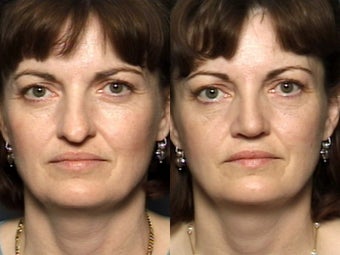 Nose Surgery