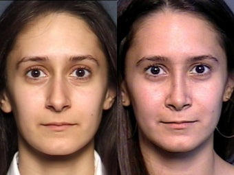 Nose Surgery