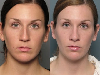 Nose Surgery