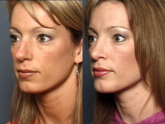 Nose Surgery