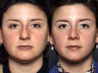 Nose Surgery